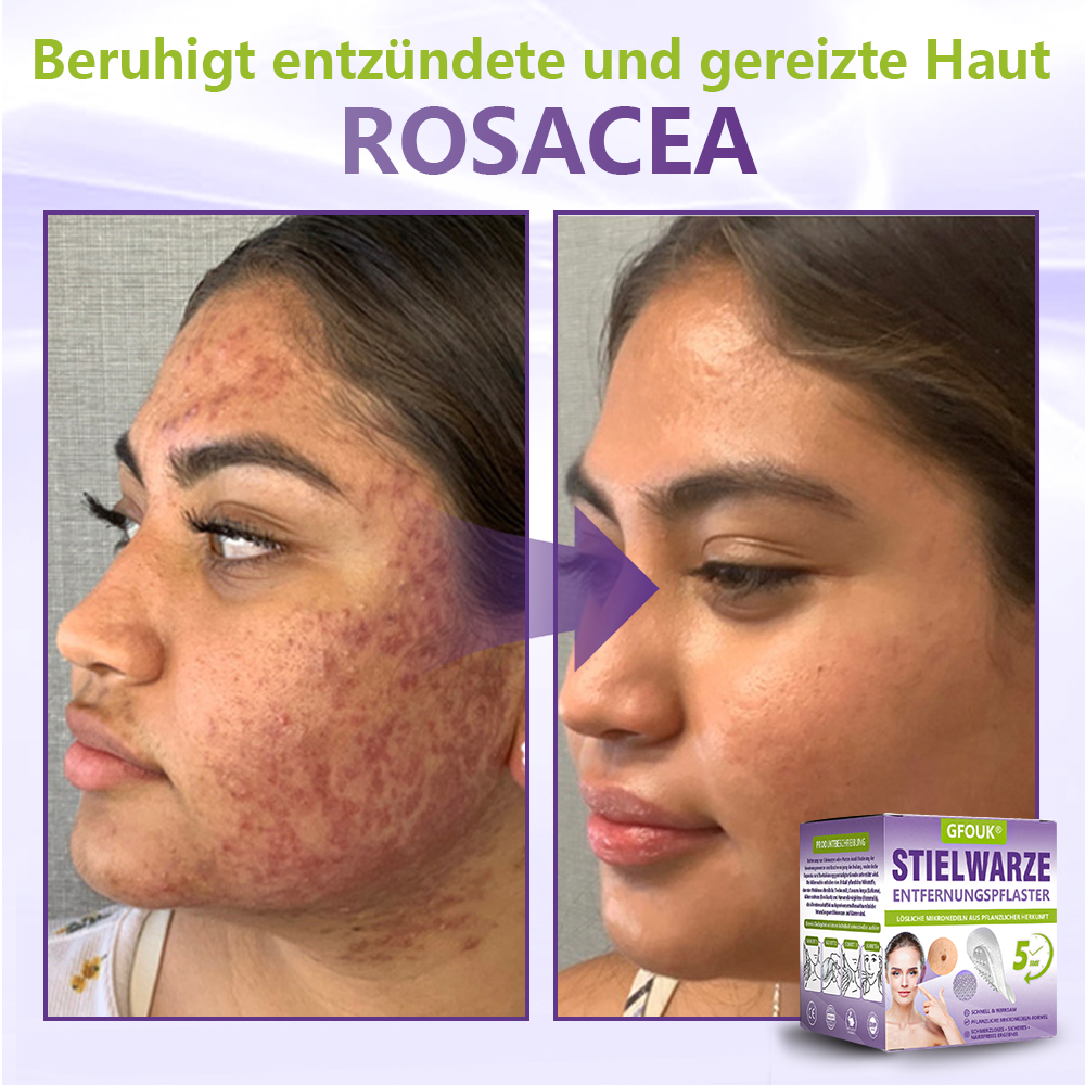 GFOUK® Lösliches Mikronadel-Pflaster zur Entfernung von Hautanhängseln auf Pflanzenbasis