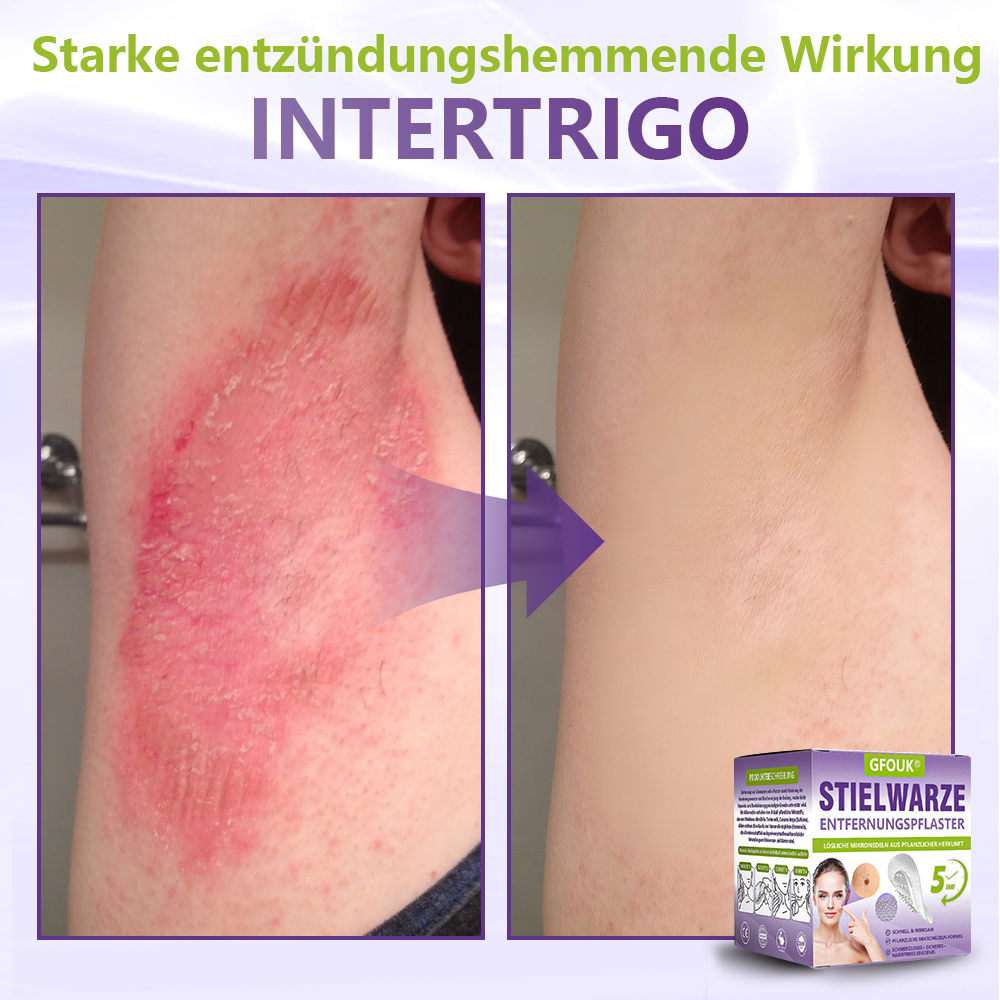 GFOUK® Lösliches Mikronadel-Pflaster zur Entfernung von Hautanhängseln auf Pflanzenbasis