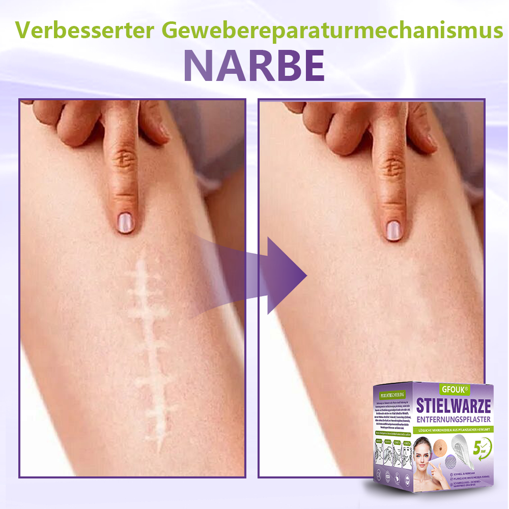 GFOUK® Lösliches Mikronadel-Pflaster zur Entfernung von Hautanhängseln auf Pflanzenbasis