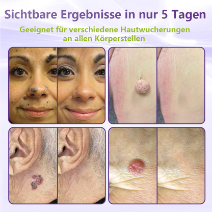 GFOUK® Lösliches Mikronadel-Pflaster zur Entfernung von Hautanhängseln auf Pflanzenbasis