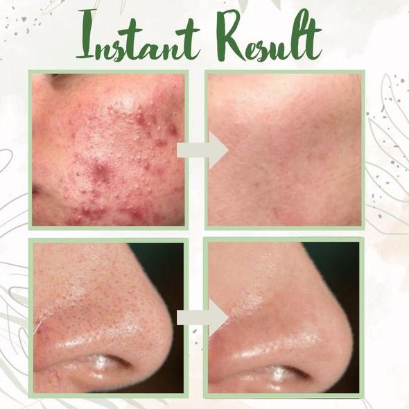 🔥LAST DAY SALE-80% OFF)Final Sale -Insideefy Holy Basil Bubble Deep Mask 13%