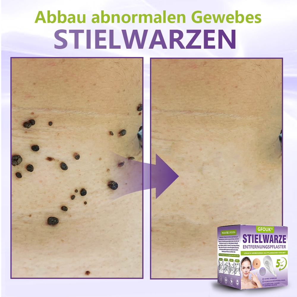 GFOUK® Lösliches Mikronadel-Pflaster zur Entfernung von Hautanhängseln auf Pflanzenbasis