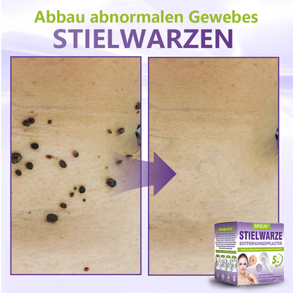 GFOUK® Lösliches Mikronadel-Pflaster zur Entfernung von Hautanhängseln auf Pflanzenbasis