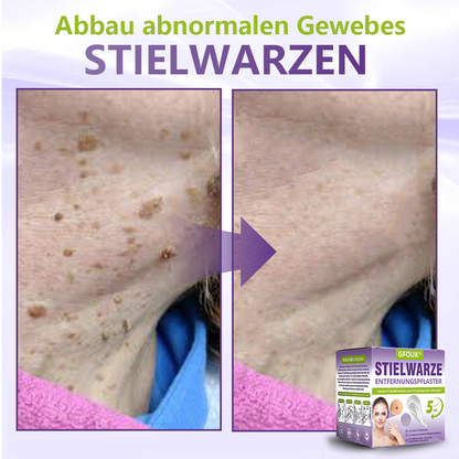 GFOUK® Lösliches Mikronadel-Pflaster zur Entfernung von Hautanhängseln auf Pflanzenbasis