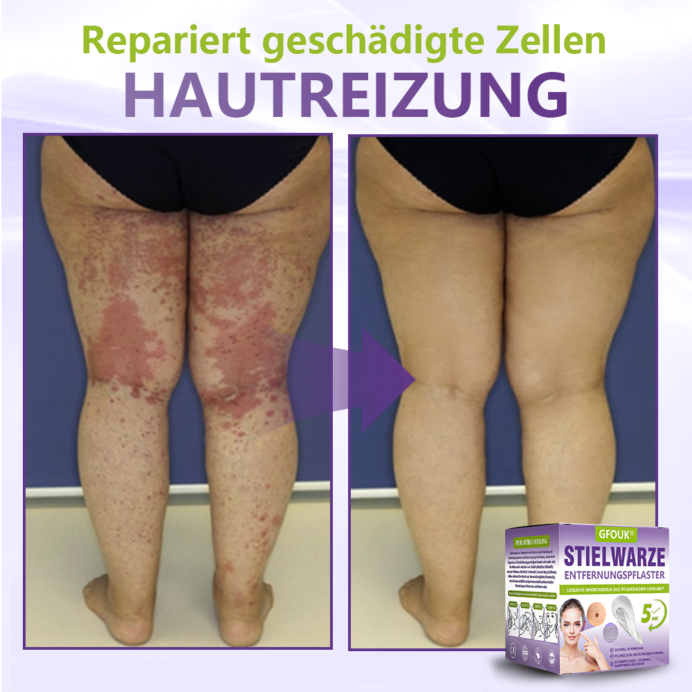 GFOUK® Lösliches Mikronadel-Pflaster zur Entfernung von Hautanhängseln auf Pflanzenbasis