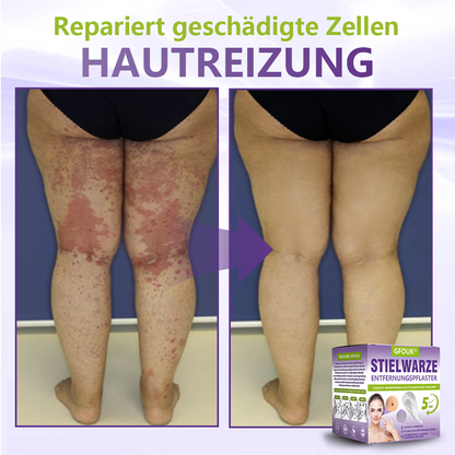 GFOUK® Lösliches Mikronadel-Pflaster zur Entfernung von Hautanhängseln auf Pflanzenbasis