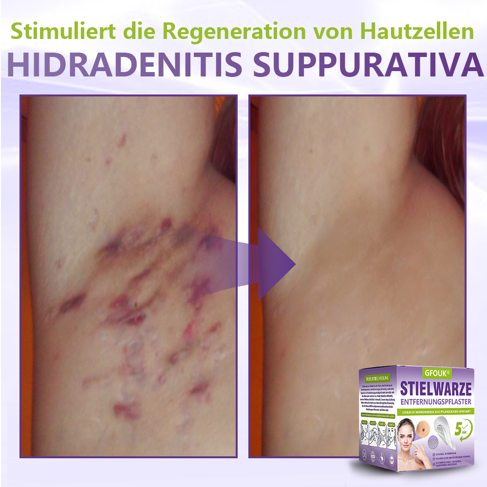GFOUK® Lösliches Mikronadel-Pflaster zur Entfernung von Hautanhängseln auf Pflanzenbasis